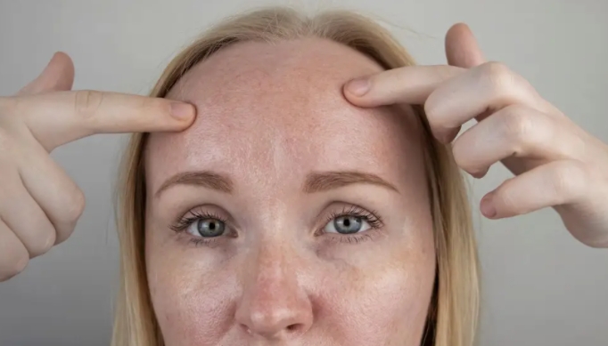 woman oily skin