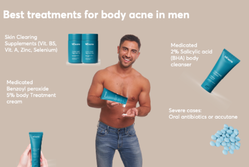 How Men Can Prevent Body Acne Through Cleansing