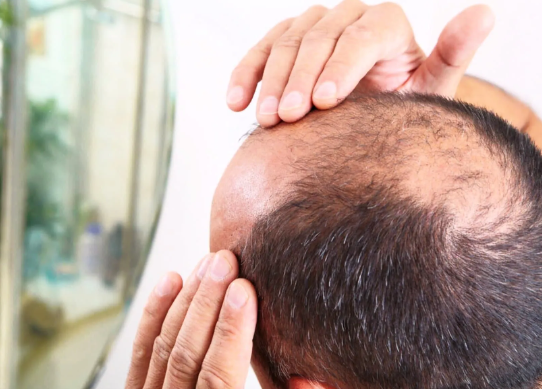 Male pattern baldness