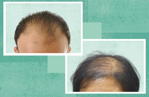 Androgenetic alopecia