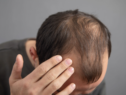 hair loss causes