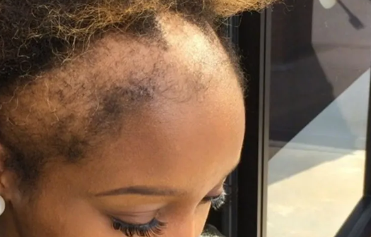 Traction alopecia