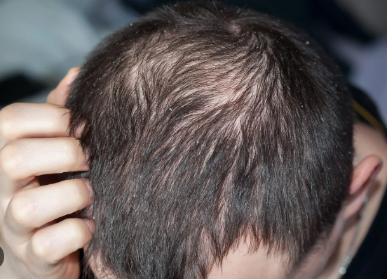 Dandruff and hair loss