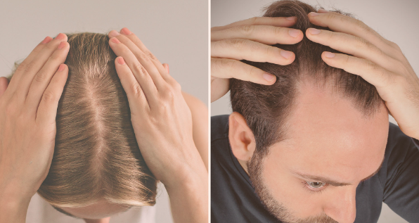 Hormonal hair loss