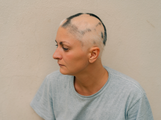 Alopecia areata is an autoimmune condition