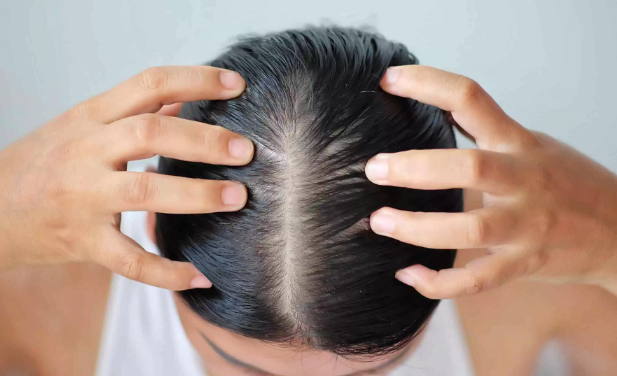 Itchy scalp and hair loss