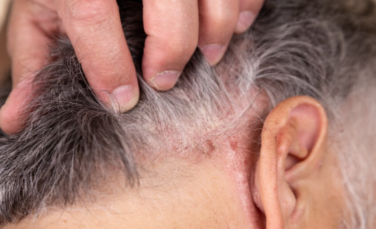 Scalp psoriasis