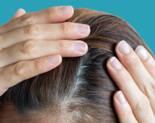 Iron deficiency can contribute to hair loss