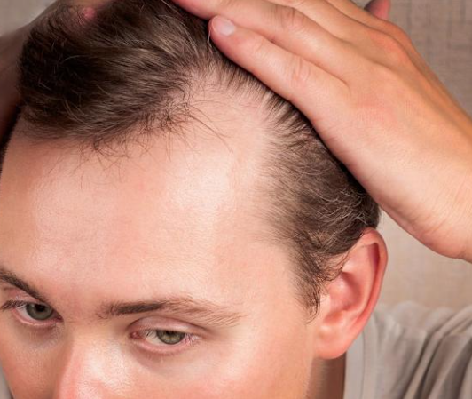 A receding hairline is a common condition