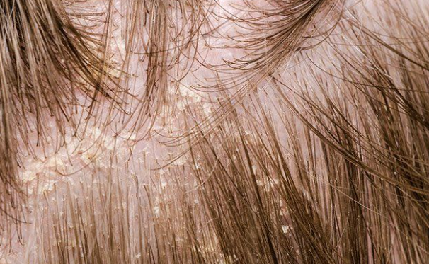 Scalp inflammation