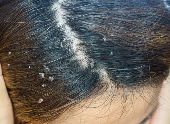 Seborrheic dermatitis