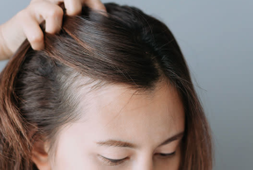 Postpartum hair loss