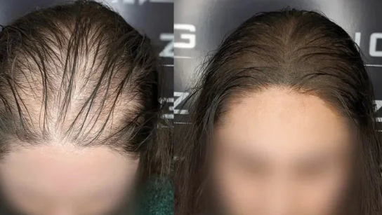 Female pattern hair loss