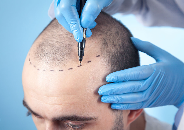 The cost of a hair transplant