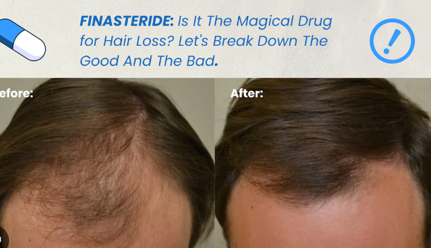 Finasteride is a medication