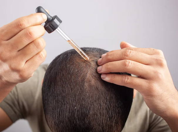 Minoxidil is a medication