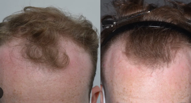 Minoxidil is a topical medication
