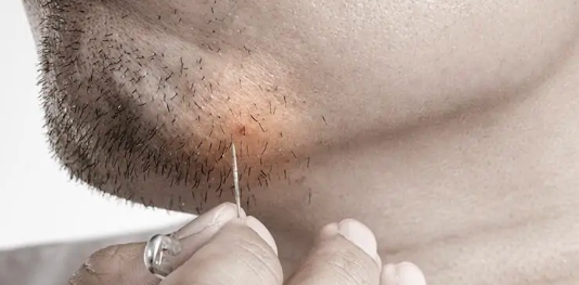How to Prevent Ingrown Hairs Through Proper Cleansing