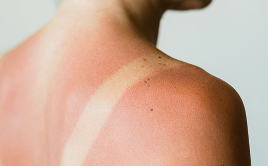 How to Cleanse Skin After Sun Exposure