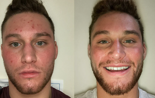 How to Prevent Sweat Buildup on Men’s Skin