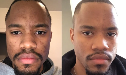 How Men Can Improve Skin Tone Through Cleansing
