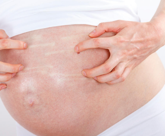 Itchy Skin During Pregnancy