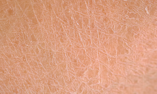 Dry Skin During Pregnancy