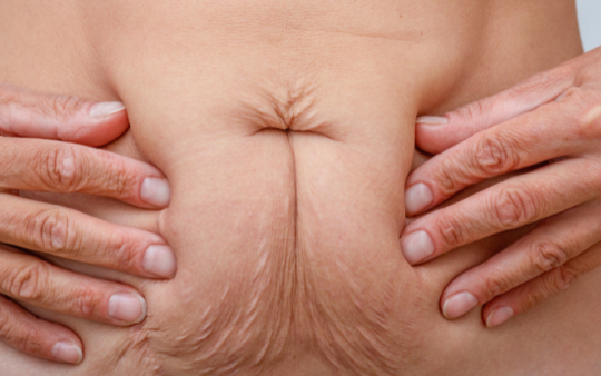 Postpartum Belly Skin Care