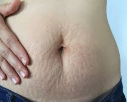 Postpartum Stretch Mark Care