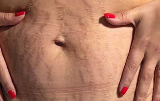 Pregnancy Stretch Mark Care