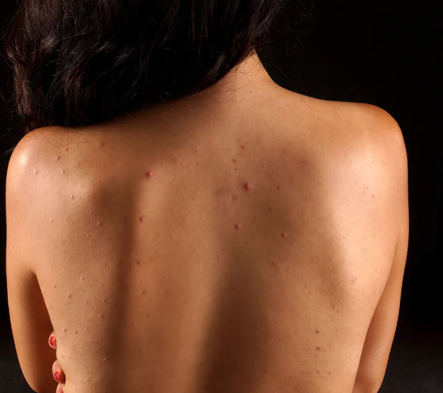Back Acne During Pregnancy