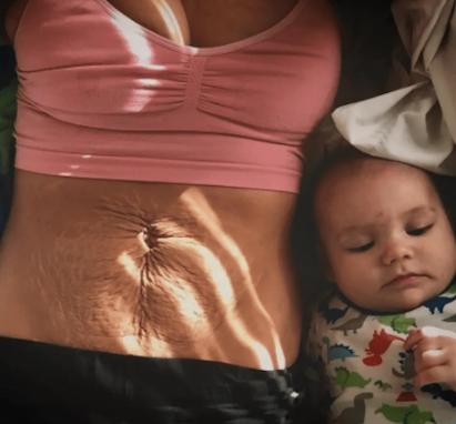 Postpartum Body Acne Care