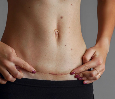 Postpartum Scar Care Tips
