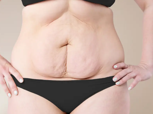 Belly Skin Care After Pregnancy